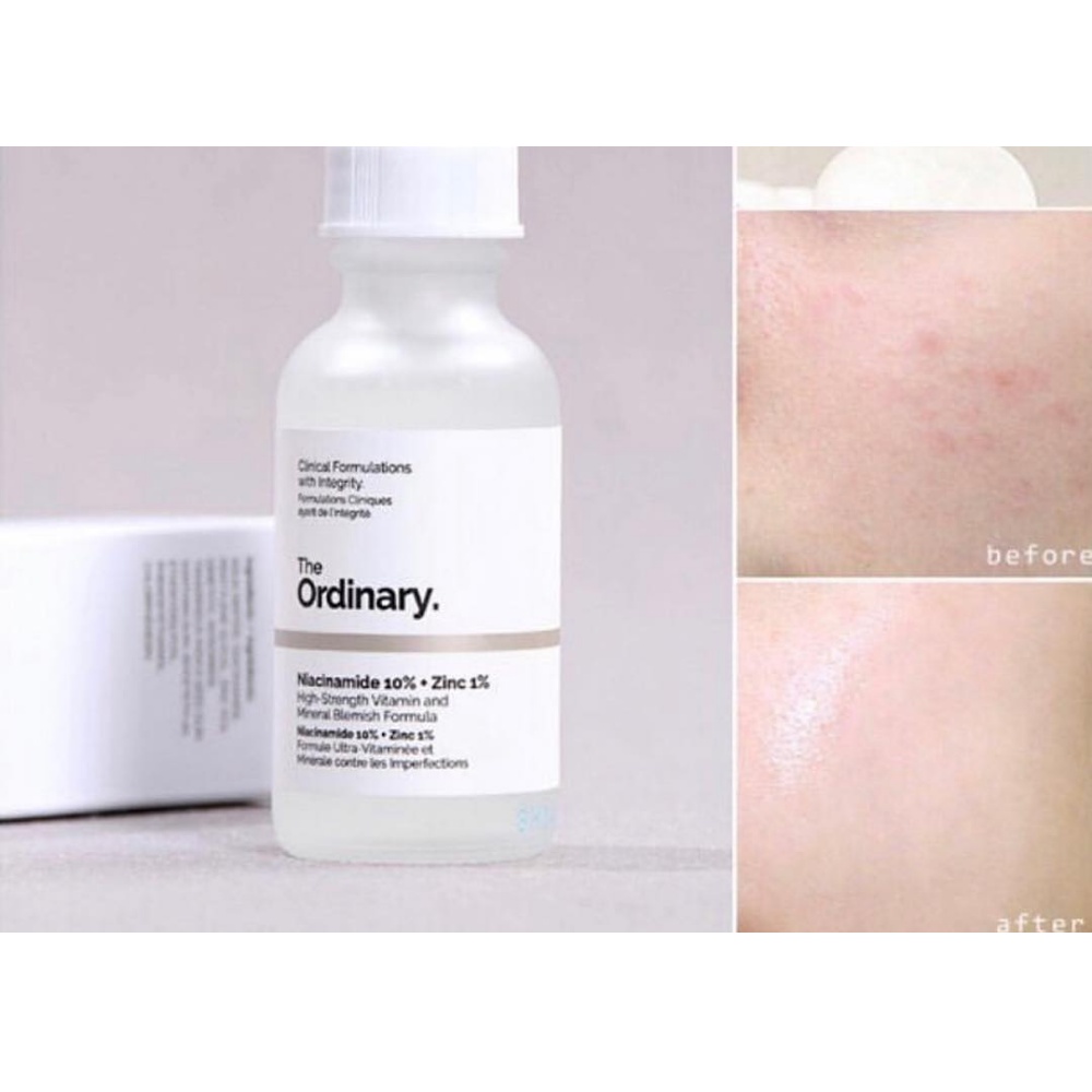 Serum The Ordinary Niacinamide 10% + Zinc 1%, Hyaluronic Acid 2% + B5, AHA 30% + BHA 2% Peeling solution - Cila House