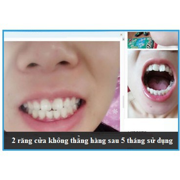 Niềng Răng Tại Nhà | Bộ người lớn A1 + A2 + A3