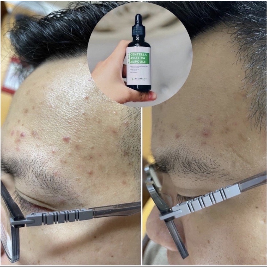 Serum giảm mụn ⚡ GIÁ SỐC ⚡ Tinh chất ngừa mụn Kyung Lab Acnes Centella Asiatica Ampoule 50ml