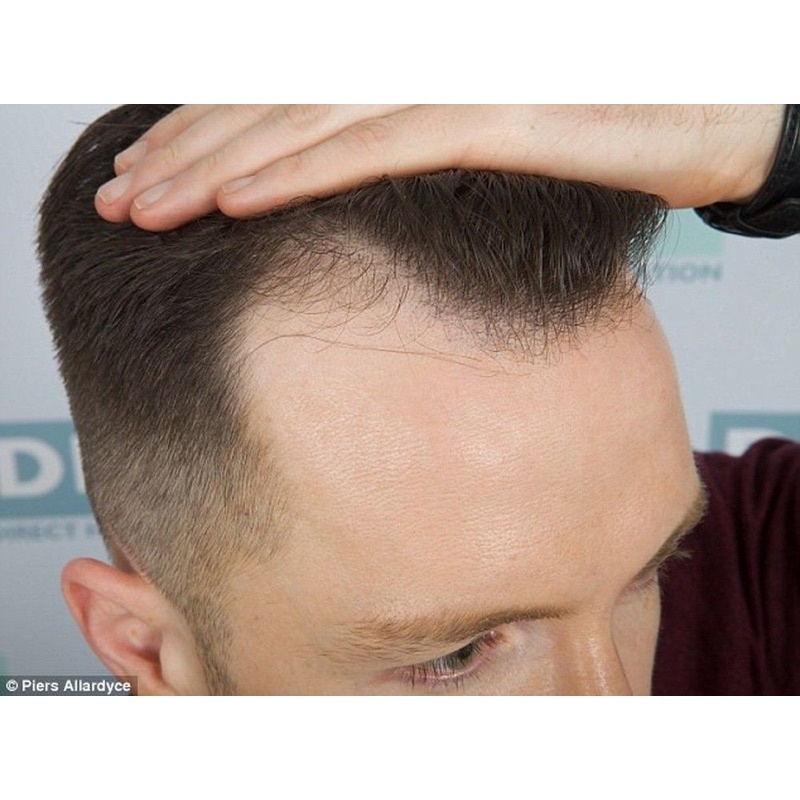 Lăn Kim ZGTS 192 Micro Needles Derma Roller 0.5mm