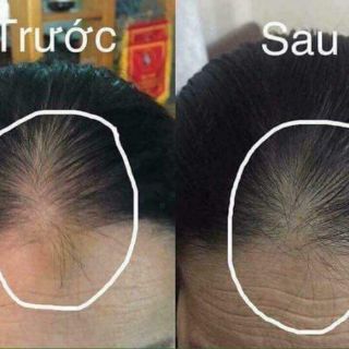 XỊT MỌC TÓC HAIR TONIC