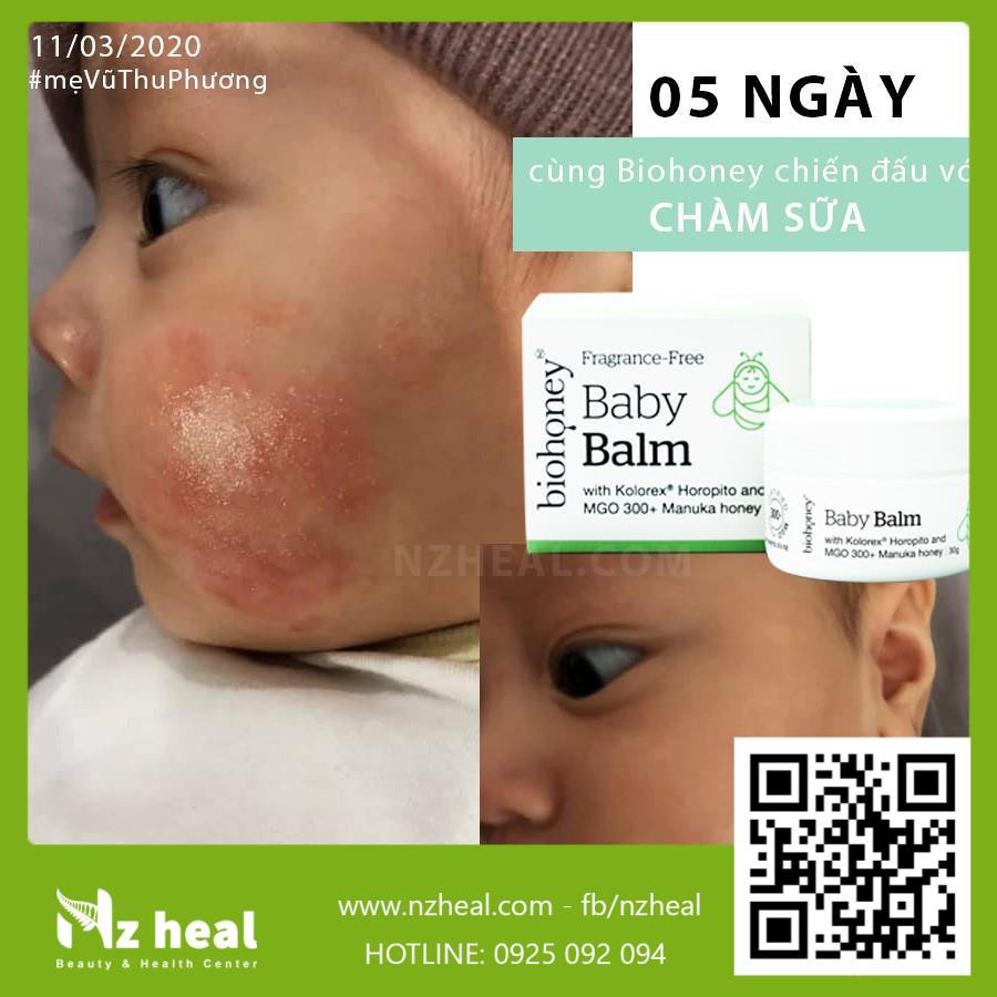 Kem Biohoney Baby Balm - Hết chàm sữa, viêm da, hăm tã, mẩn ngứa cho trẻ