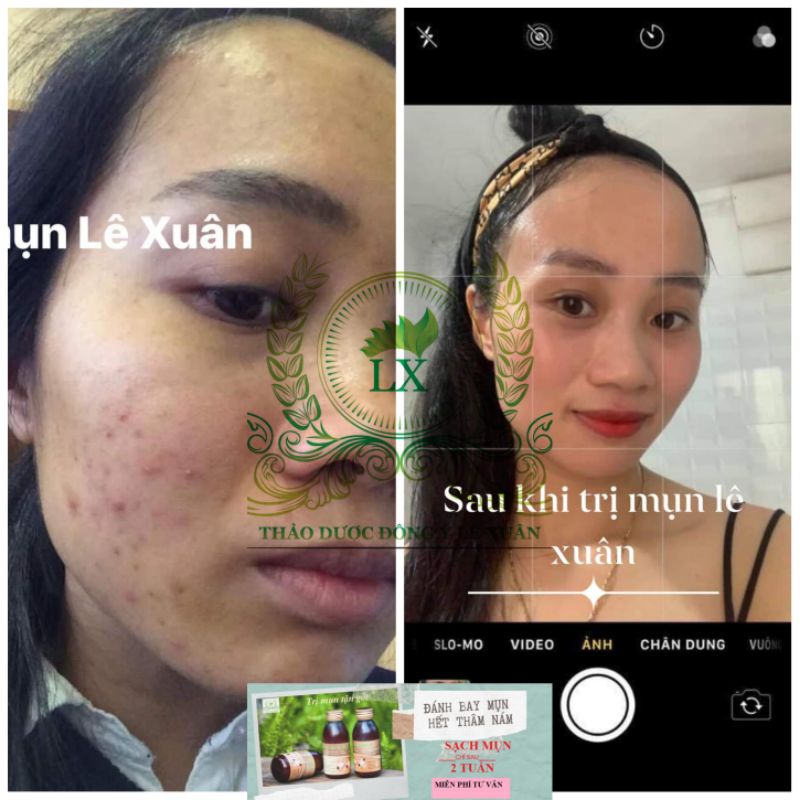 Tinh chất ngừa mụn trứng cá Lê Xuân 🍀Free ship☘️loại bỏ mụn đầu đen, mụn ẩn, mụn bọc,… | BigBuy360 - bigbuy360.vn
