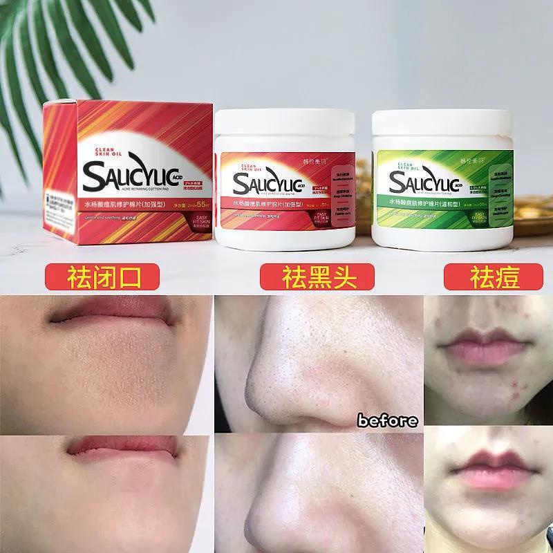 ❣♗Miếng lót Cotton axit Salicylic loại bỏ mụn đầu đen hiệu quả | BigBuy360 - bigbuy360.vn