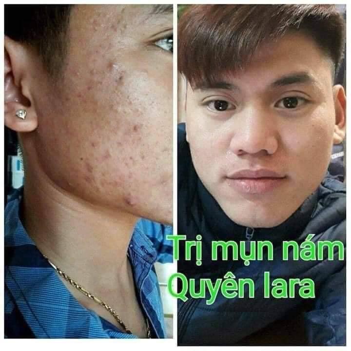 Mụn Nám Thảo Dược QuyênLara Đánh Bay Mụn,Nám,Tàn Nhang ,Tái Tạo Lại Làn Da Mới An Toàn,Hiệu Quả Sau 1 Liệu Trình 150Ml