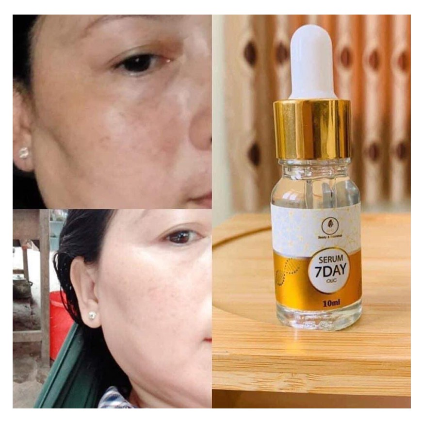 Serum truyền trắng da 7 ngày olic, Huyết thanh 7days olic