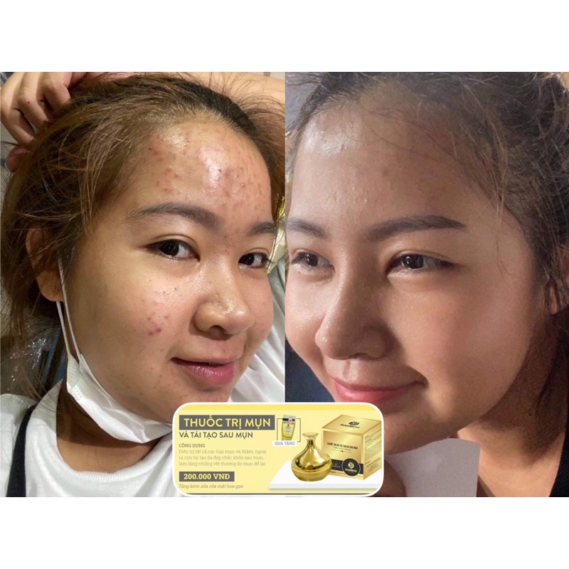 Kem Giảm Mụn Bamboo, Serum B5 Bamboo - Combo giảm mụn, phục hồi da hiệu quả