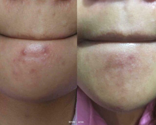 [NEW] ☣ GEL trị mụn HERBAL ACNE