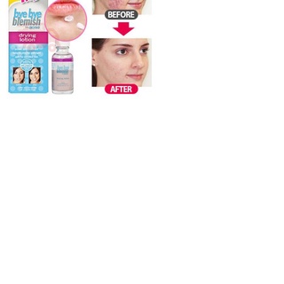 Chấm mụn bye bye blemish for acne drying lotion