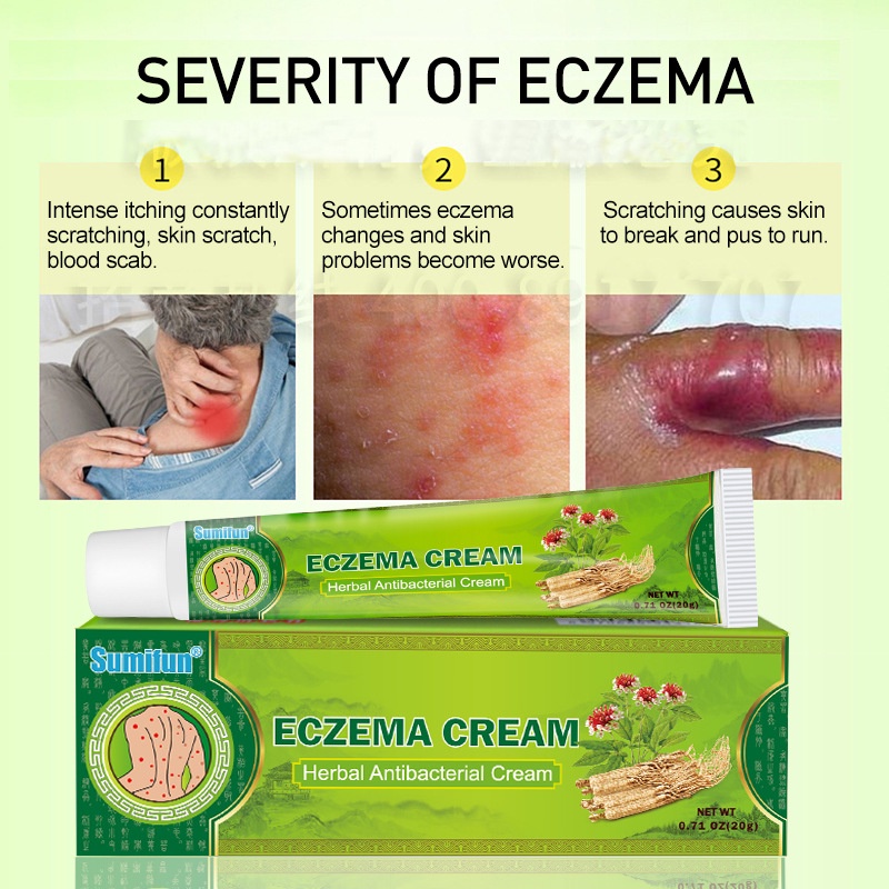 Kem hỗ trợ bôi chàm ngứa ECZEMA, tinh chất thảo dược thiên nhiên