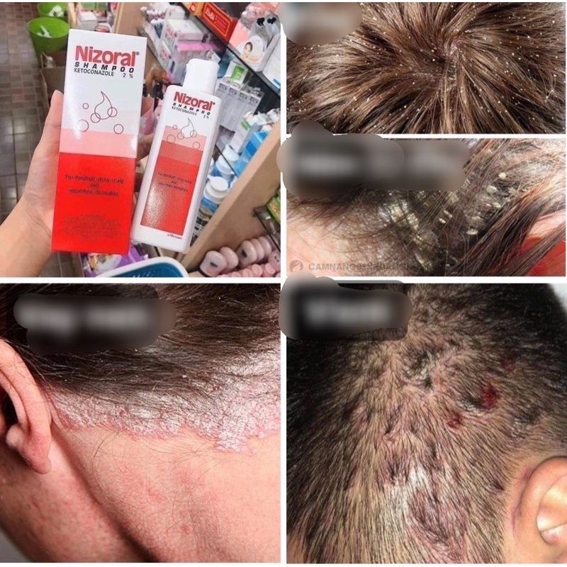 DẦU GỘI ĐẦU NIZO_RAL GAU,NÂM,VIEM TÓC THÁI LAN[SẴN]