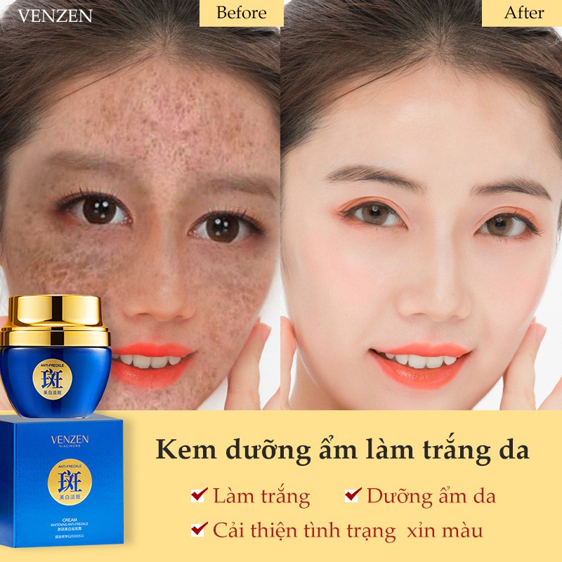 Nhiều vấn đề về da chỉ cần 1 giải pháp VENZEN  50g Giảm các đốm sắc tố （kem điều trị nám tàn nhang）