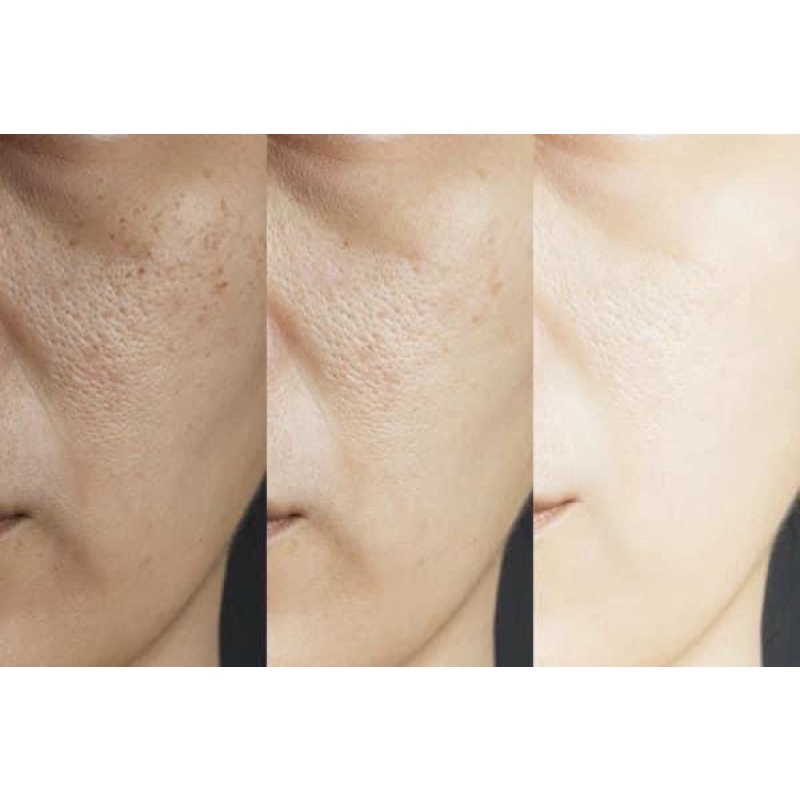 Tinh chất men vi sinh ildong se khít lỗ chân lông