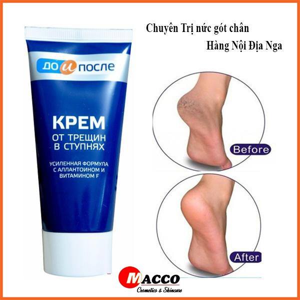 Kem Trị Nứt Nẻ Gót Chân Kpem Nga 50ml