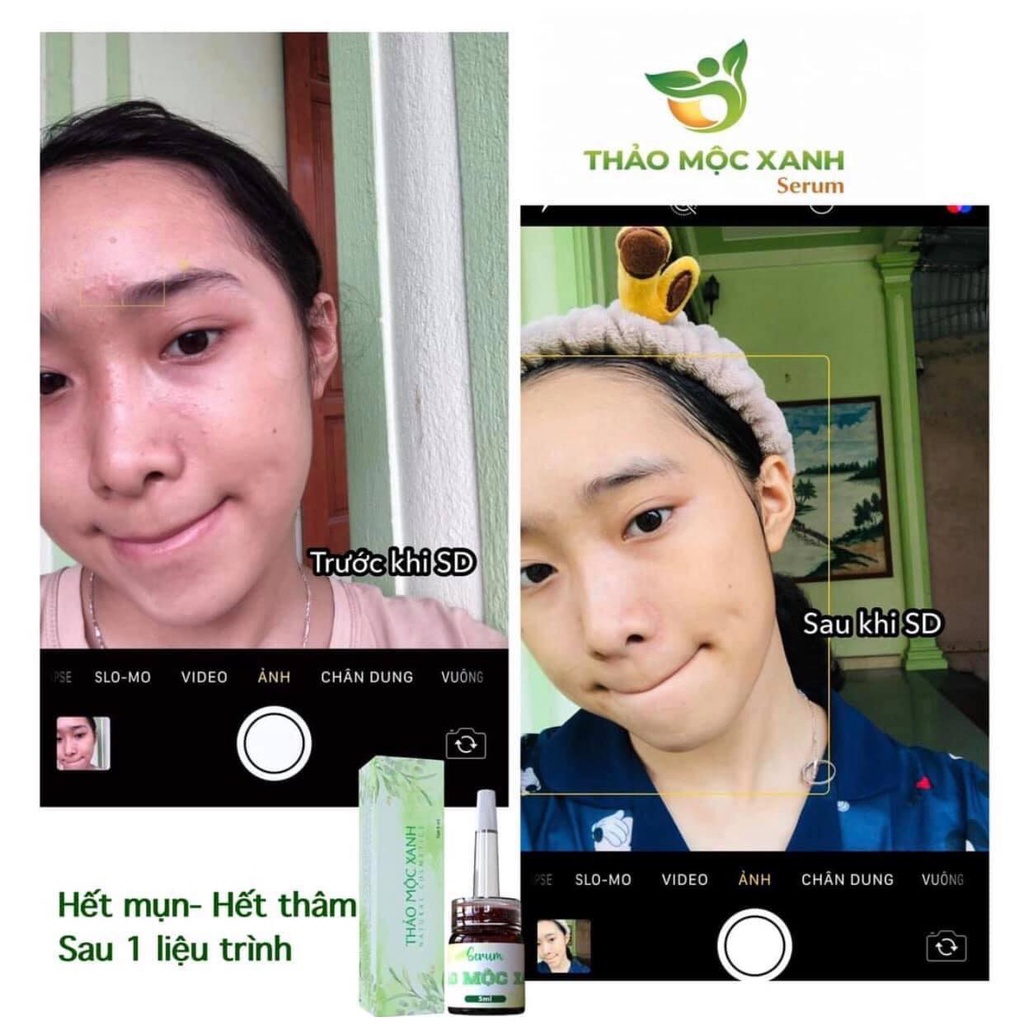 Combo 5 Hộp Serum Thảo Mộc Xanh Hàng Chính Hãng