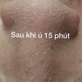 🇺🇸🇺🇸Ủ MỤN ĐẦU ĐEN ĐẦU TRẮNG SUPER X LOTION