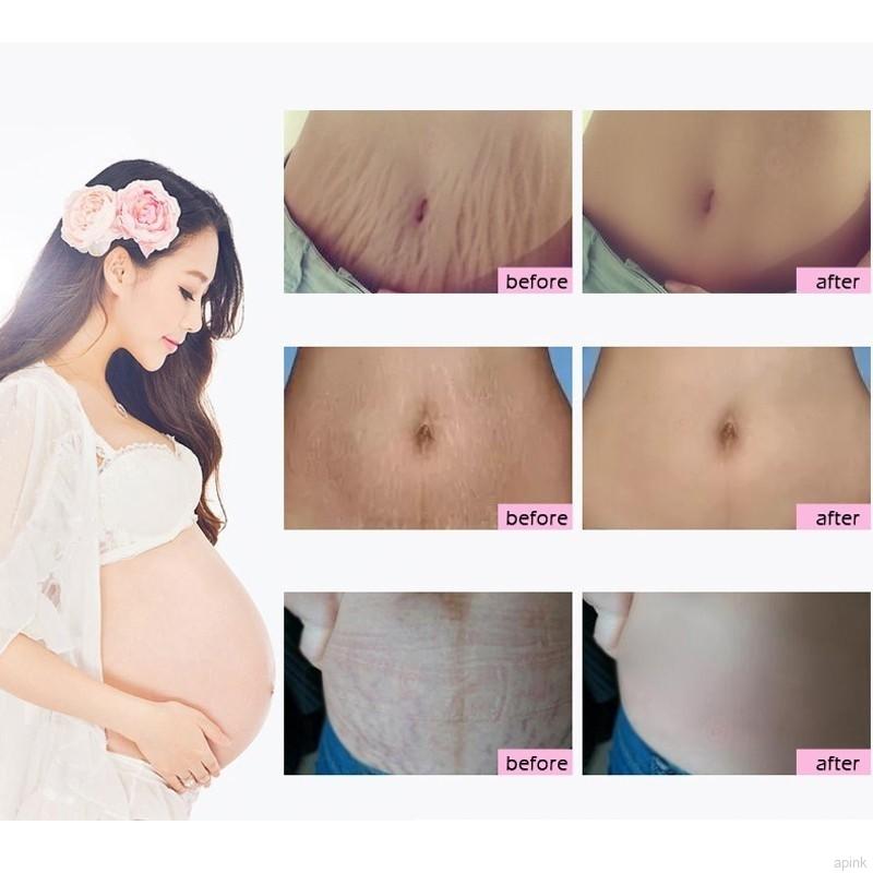 Kem cải thiện tình trạng rạn da sẹo rỗ dành cho mẹ bầu 40g