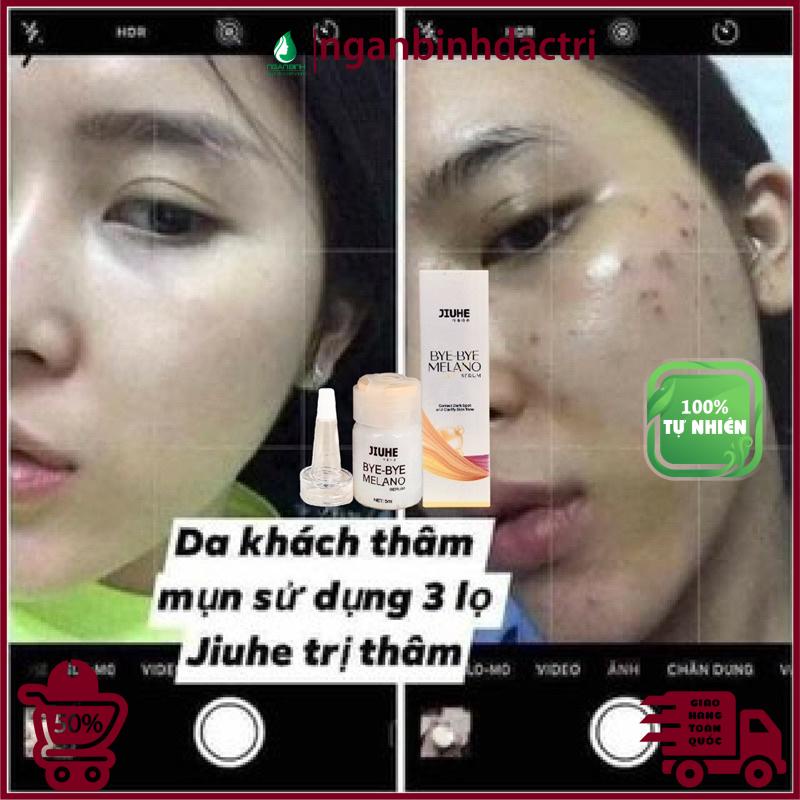 Serum tri thâm hàn quốc JIUHE Q-PEARL giảm thâm do mụn khửu tay chân, thâm sẹo, thâm nách hiệu quả