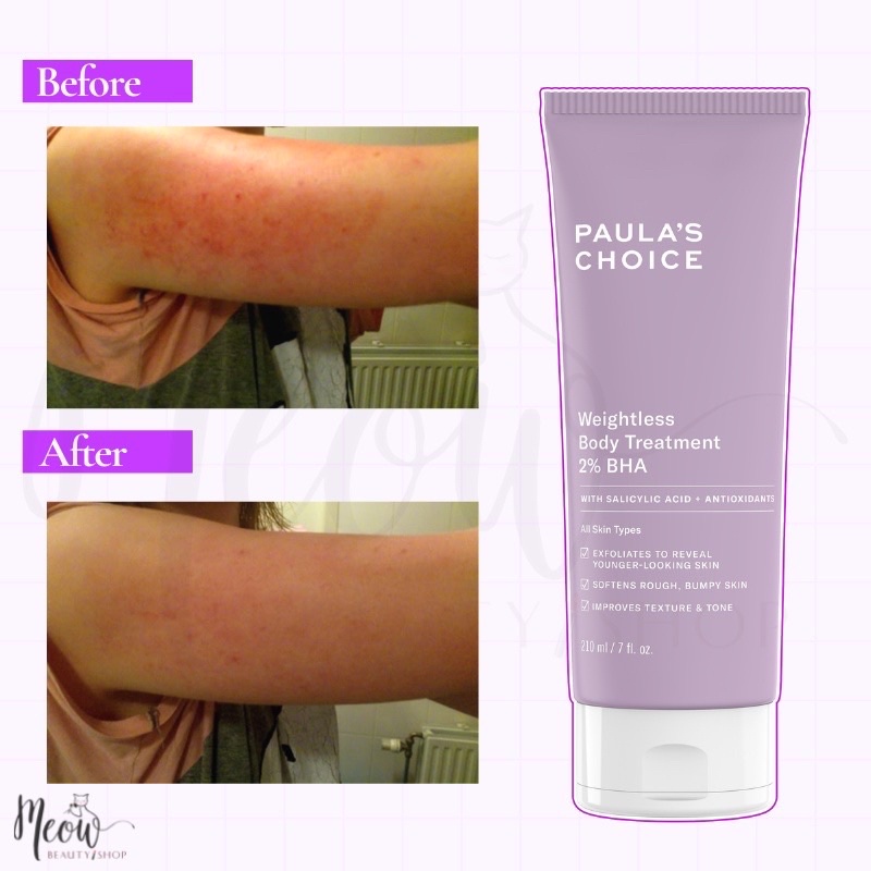 2% BHA Kem dưỡng thể ngừa viêm lỗ chân lông Paula's Choice Weightless Body Treatment 2% BHA 210ml