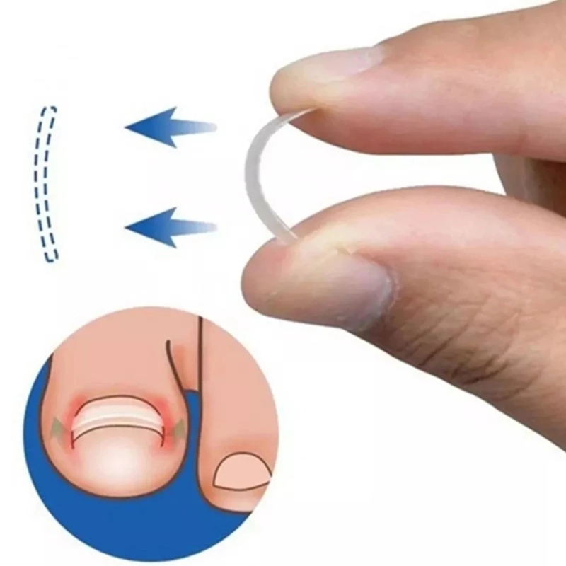 1 Set Miếng Dán Chỉnh Hình Móng Chân Mềm Mại Đàn Hồi Tự Dính