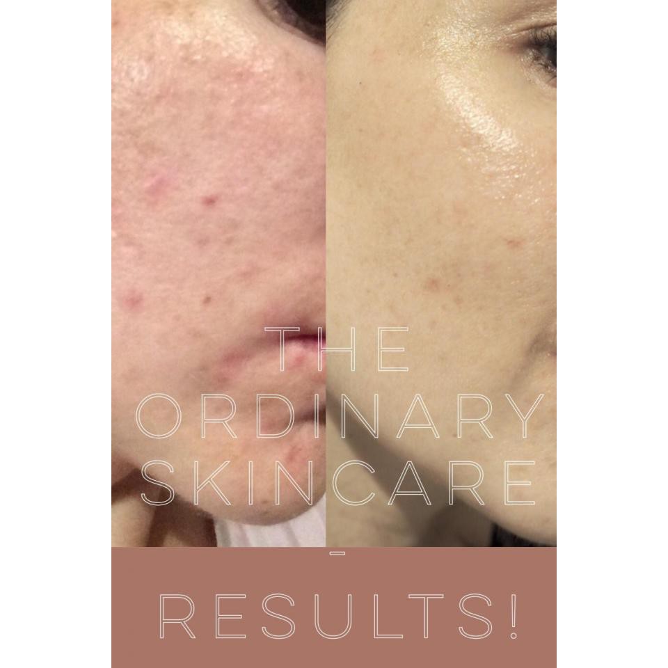 The Ordinary - Tinh Chất Serum The Ordinary Lactic Acid 5% - 10% + HA 2% | BigBuy360 - bigbuy360.vn