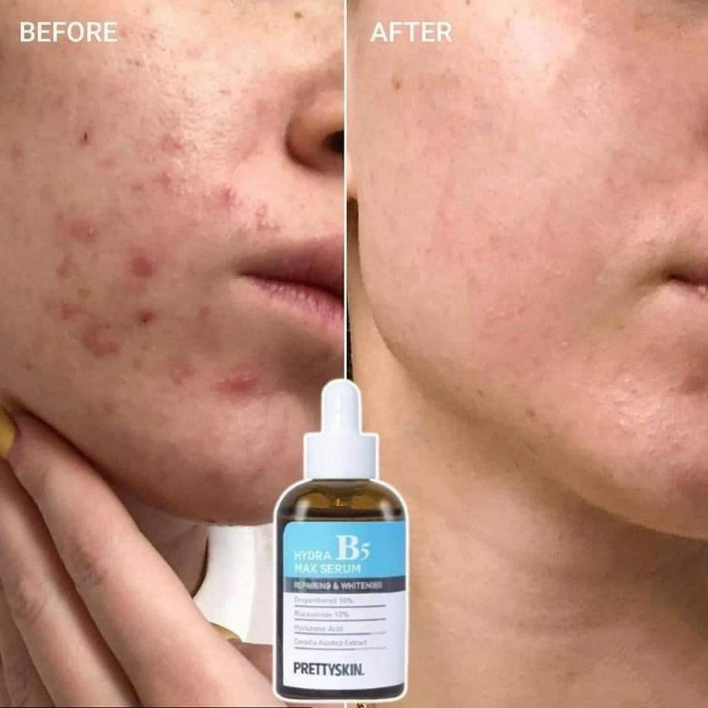 Serum phục hồi da b5 prettyskin Hàn Quốc 50ml giúp phục hồi da dưỡng trắng dưỡng ẩm chuyên sâu