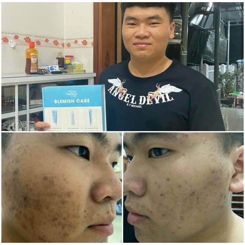 Combo Ngừa Mụn Mờ Thâm RIORI BLEMISH CARE