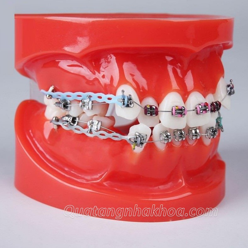 Mô hình mẫu hàm tư vấn chỉnh nha/ niềng năng đầy đủ mắc cài, dây cung, khí cụ - Mô hình răng nha khoa