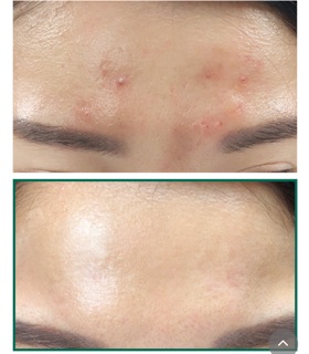 TONER AHA – BHA – PHA Miracle SOME BY MI