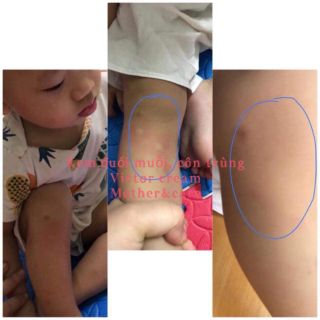 Kem chống - trị muỗi và côn trùng đốt (trị cả chấy nha)
