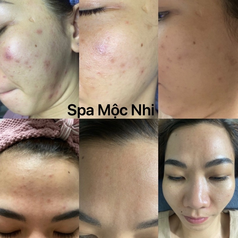 SerumComplex AC ampoule isov 1lọ 10ml