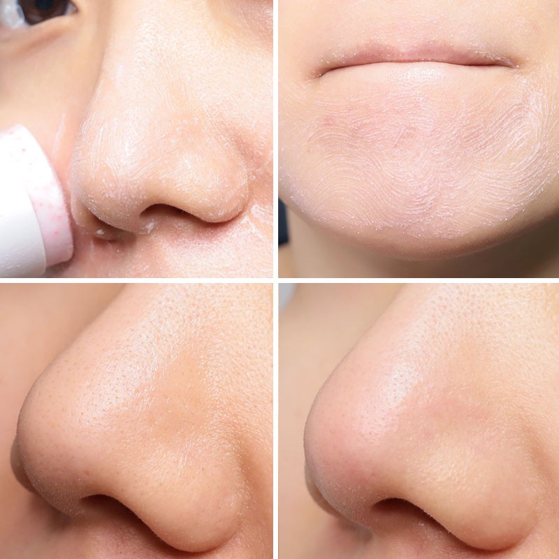 Thanh Lăn So'Natural Làm Giảm Mụn Đầu Đen Dạng Sáp Red Peel Clear Stick Pore Blackhead &amp; Face 23g