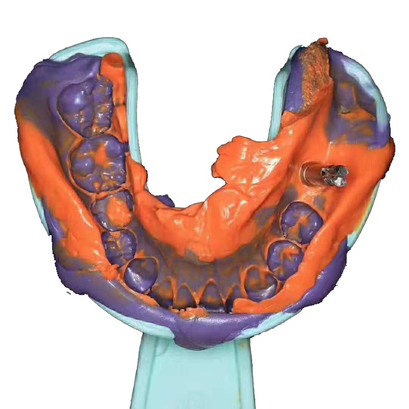 THÌA LẤY DẤU IMPLANT - THÌA LẤY DẪU RĂNG IMPLANT NHA KHOA