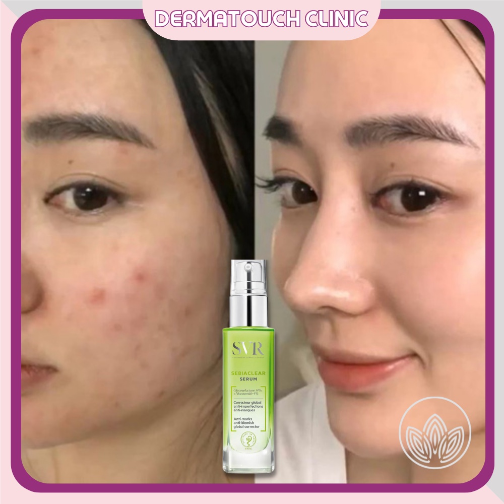 ✅[Chính Hãng] Serum SVR Sebiaclear giảm mụn, giảm thâm, phục hồi và cân bằng da