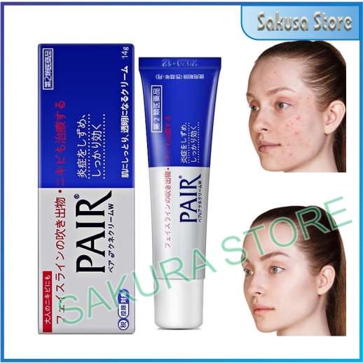 Kem ngừa mụn Pair Acne W Cream Nhật Bản giúp giảm mụn se khít lỗ chân lông