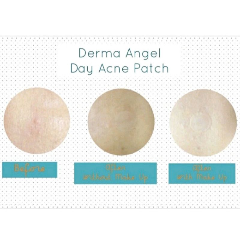 Miếng dán mụn Ban ngày và Ban đêm Derma Angel