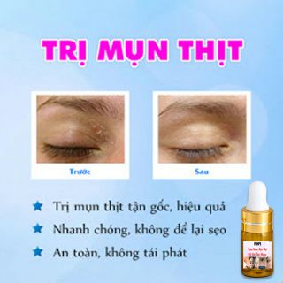 🌺Kem Xóa Nốt Ruồi