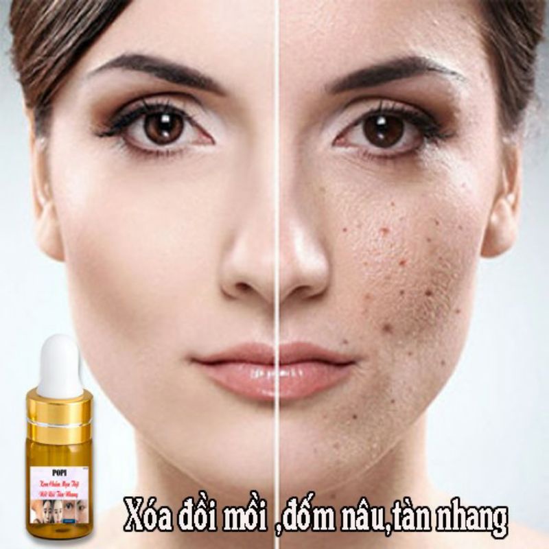 Kem Xóa Nốt Ruồi, Tàn Nhang,Mụn Thịt, Mụn Cóc,Mắc Cá POPI