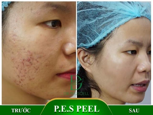 [TRỢ GIÁ] Bộ 2 Pes peel mụn Dr Pluscell