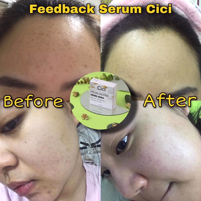 HỘP SERUM MỤN🌱