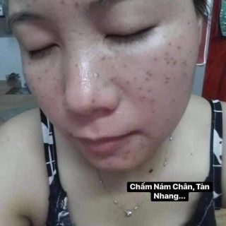 PEEL THAY DA MẶT TCA_USA