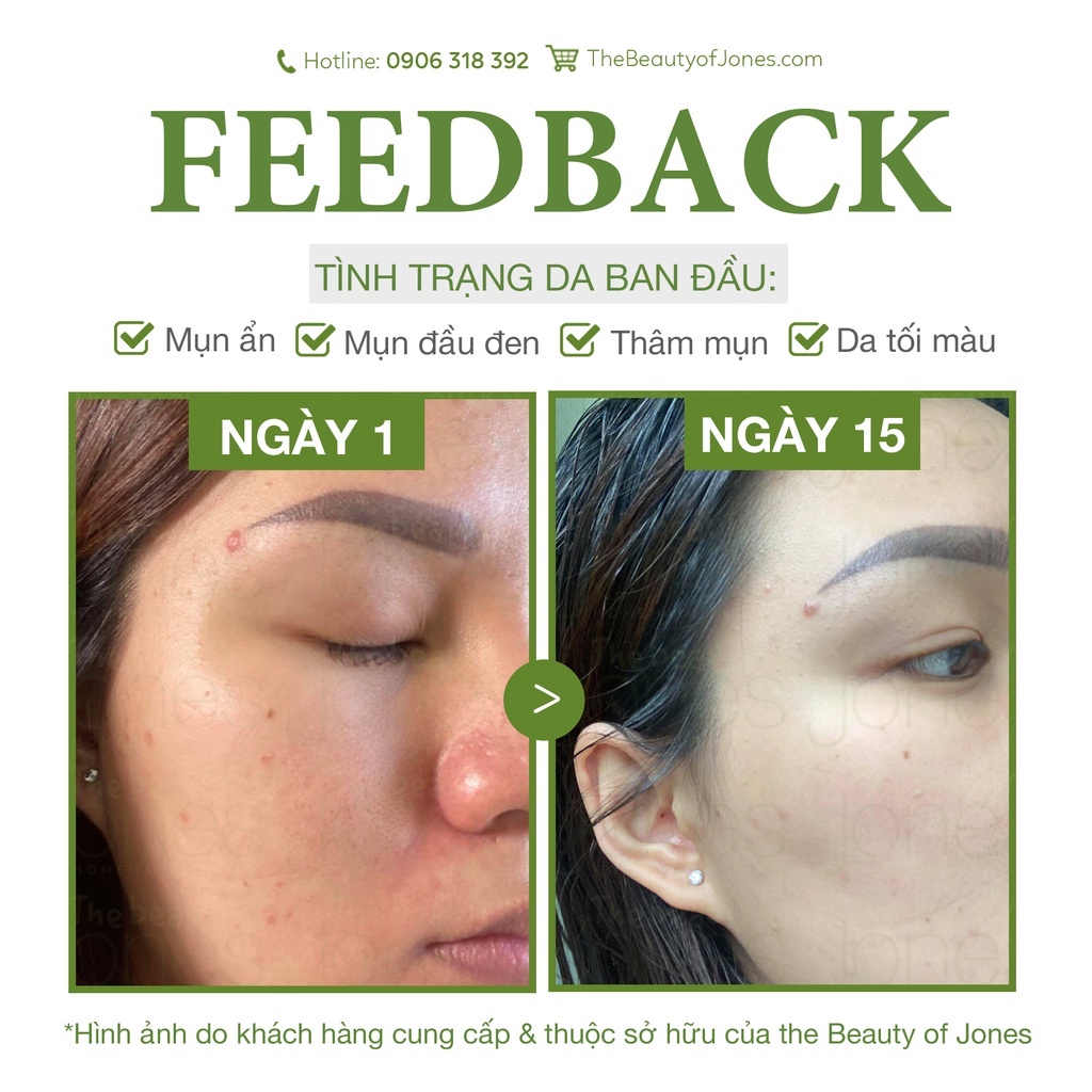 Bộ đôi làm sạch sâu cho da dầu mụn The Beauty of Jones2022 | BigBuy360 - bigbuy360.vn
