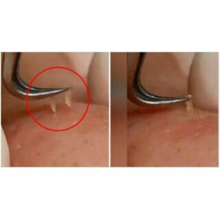 Nhíp gắp mụn