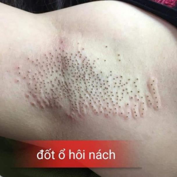 Trị hôi nách đốt ổ hôi nách spa thẫm mỹ viện