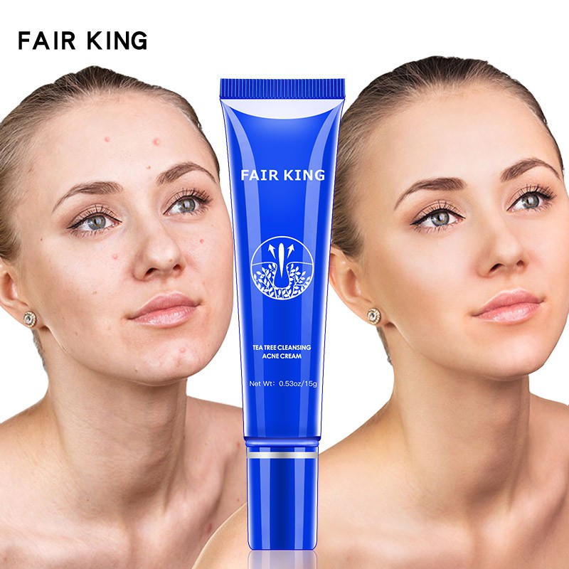 FAIR KING Loại bỏ Kem chống mụn làm trắng da mặt Làm sạch sâu Trị mụn Sẹo Thu nhỏ lỗ chân lông Điều trị Kem chăm sóc da mặt Sửa chữa mụn đầu đen