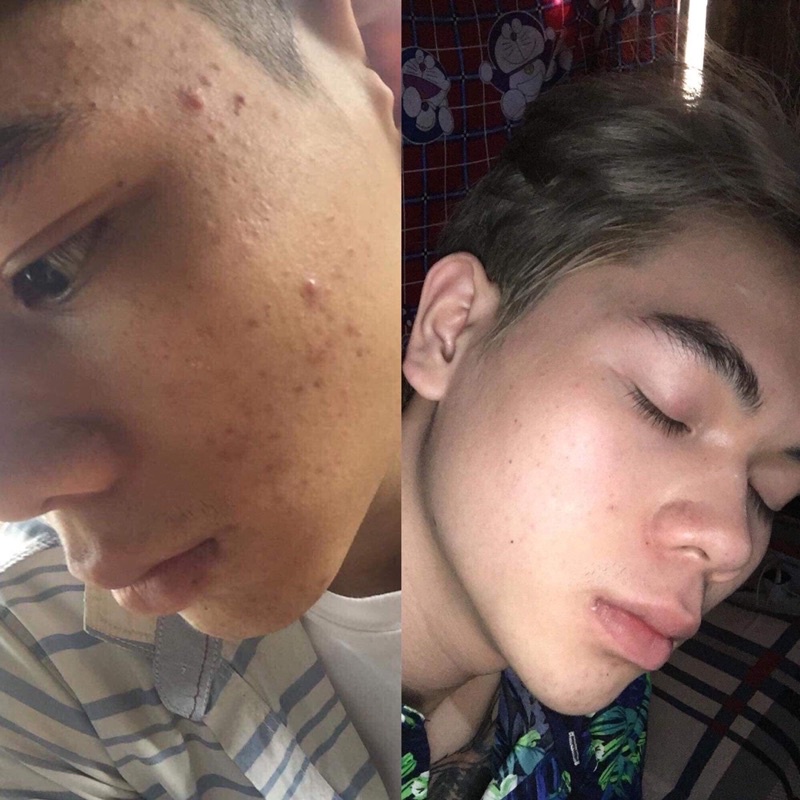 Tái tạo ngọc linh sâm giúp cho làn da hết mụn | BigBuy360 - bigbuy360.vn