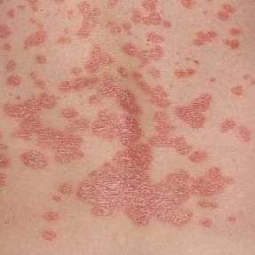 Kem bôi da liễu hỗ trợ Viêm da cơ địa, nấm ngứa, chàm, tổ đỉa,ghẻ nước,hắc lào ,lang ben, vảy nến | giảm ngứa nhanh | BigBuy360 - bigbuy360.vn