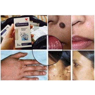 Gel tẩy nốt ruồi, mụn cóc, mụn thịt Nga