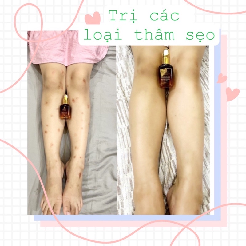 TINH CHẤT MỜ THÂM ĐA NĂNG MINH KHANG⚡mờ thâm siêu tốc⚡, thâm mắt, môi,thâm sẹo⚡tặng kèm quà | BigBuy360 - bigbuy360.vn