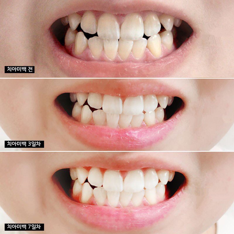 Kem đánh răng Hàn Quốc Median Dental  IQ 93% 120g hỗ trợ làm trắng bảo vệ men răng Mya Cosmetic